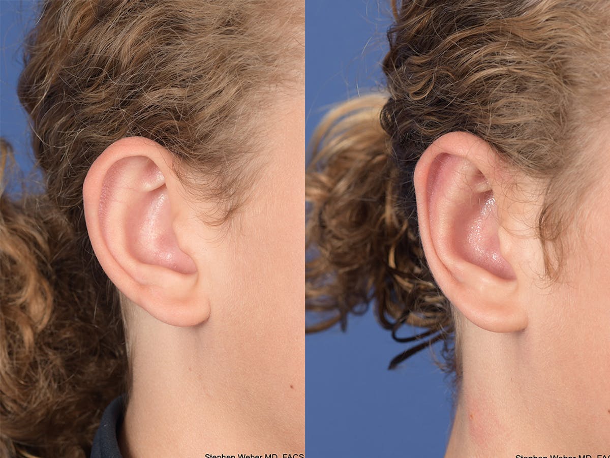 Otoplasty Before & After Gallery - Patient 288731 - Image 3