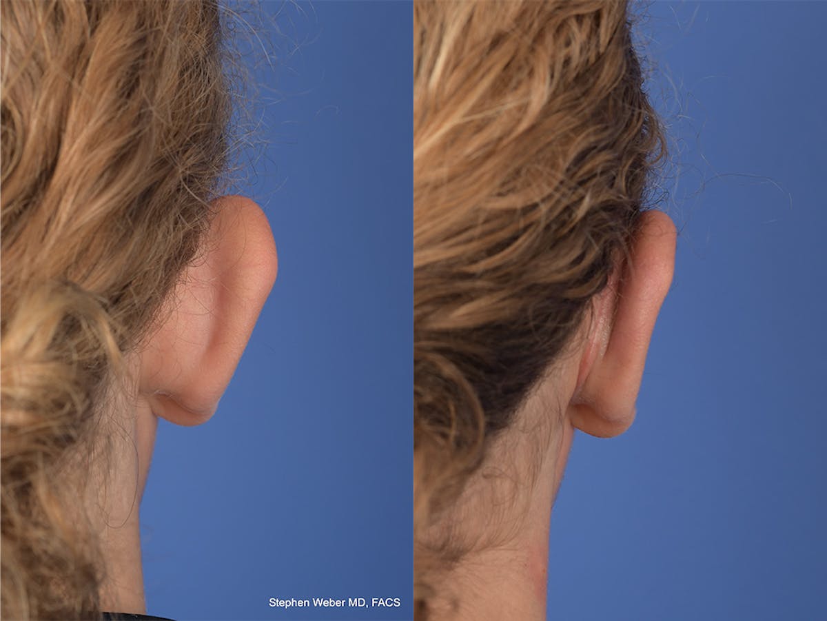 Otoplasty Before & After Gallery - Patient 288731 - Image 4