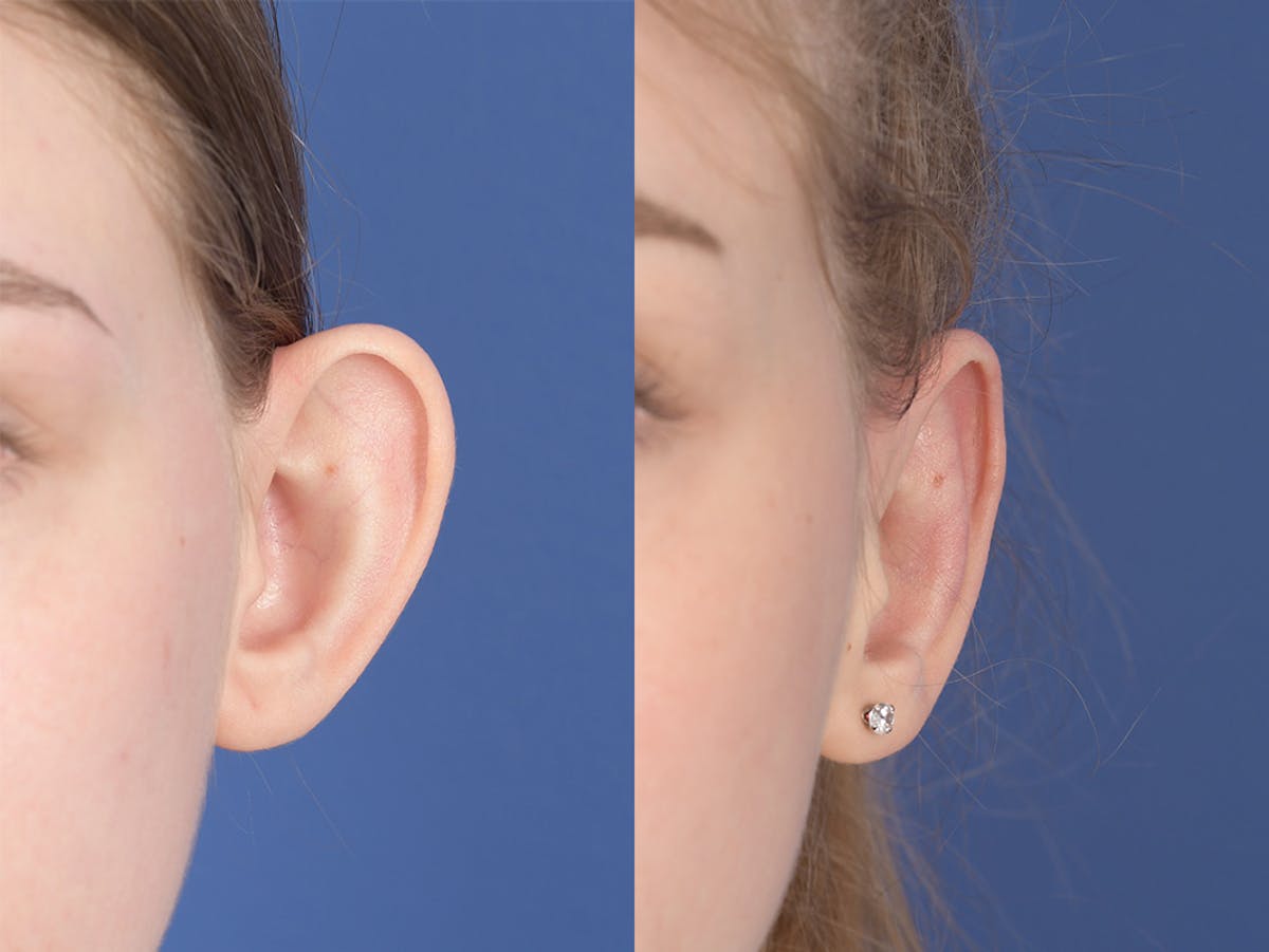 Otoplasty Before & After Gallery - Patient 276010 - Image 1