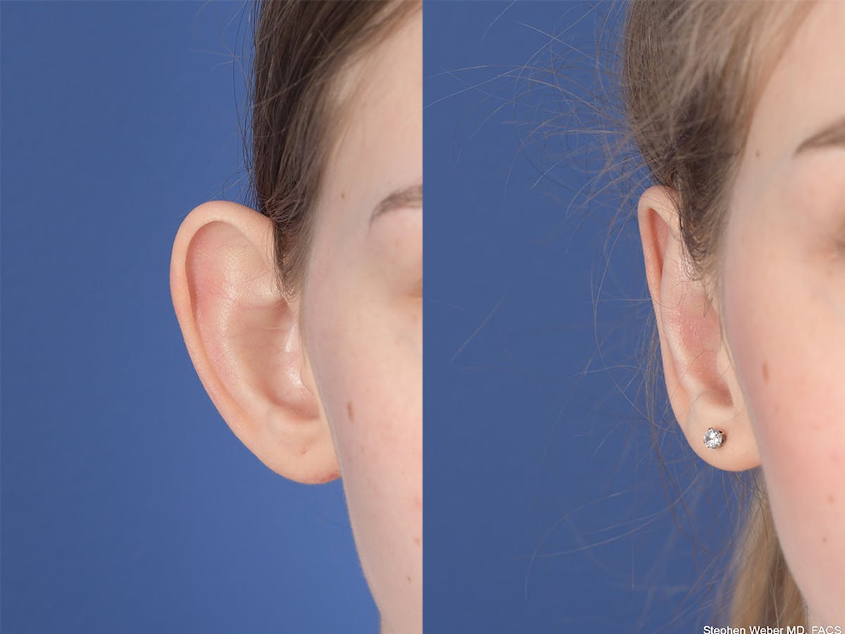 Otoplasty Before & After Gallery - Patient 276010 - Image 2