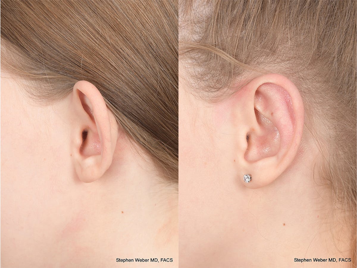 Otoplasty Before & After Gallery - Patient 276010 - Image 3