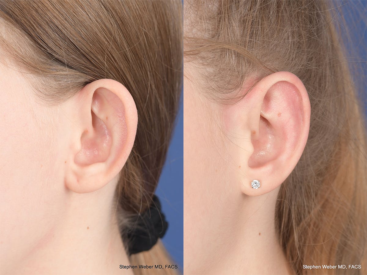 Otoplasty Before & After Gallery - Patient 276010 - Image 4