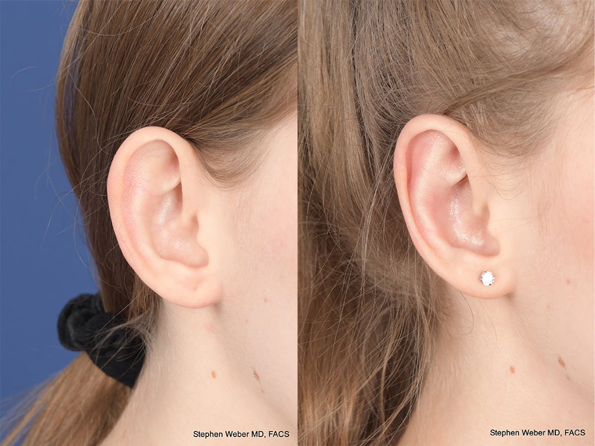 Otoplasty Before & After Gallery - Patient 276010 - Image 5