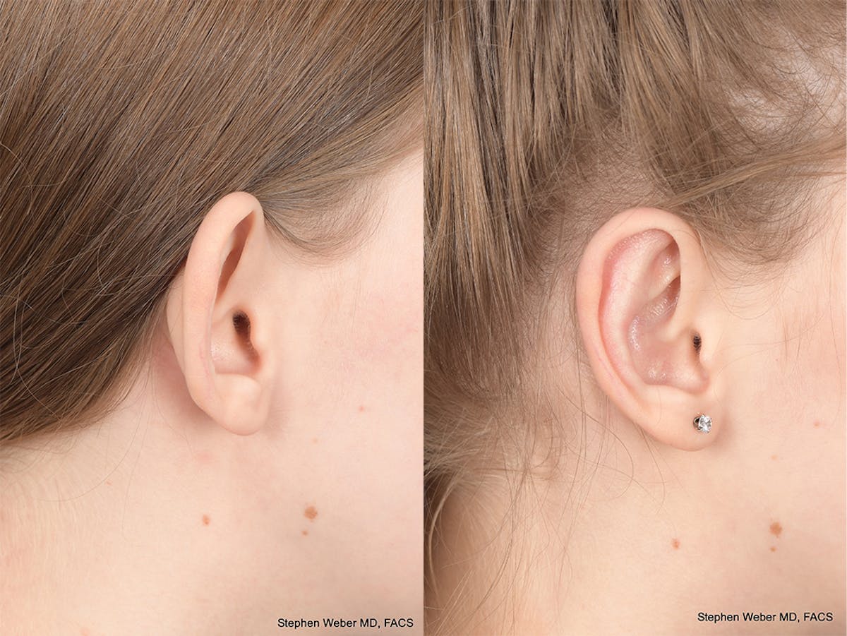 Otoplasty Before & After Gallery - Patient 276010 - Image 6