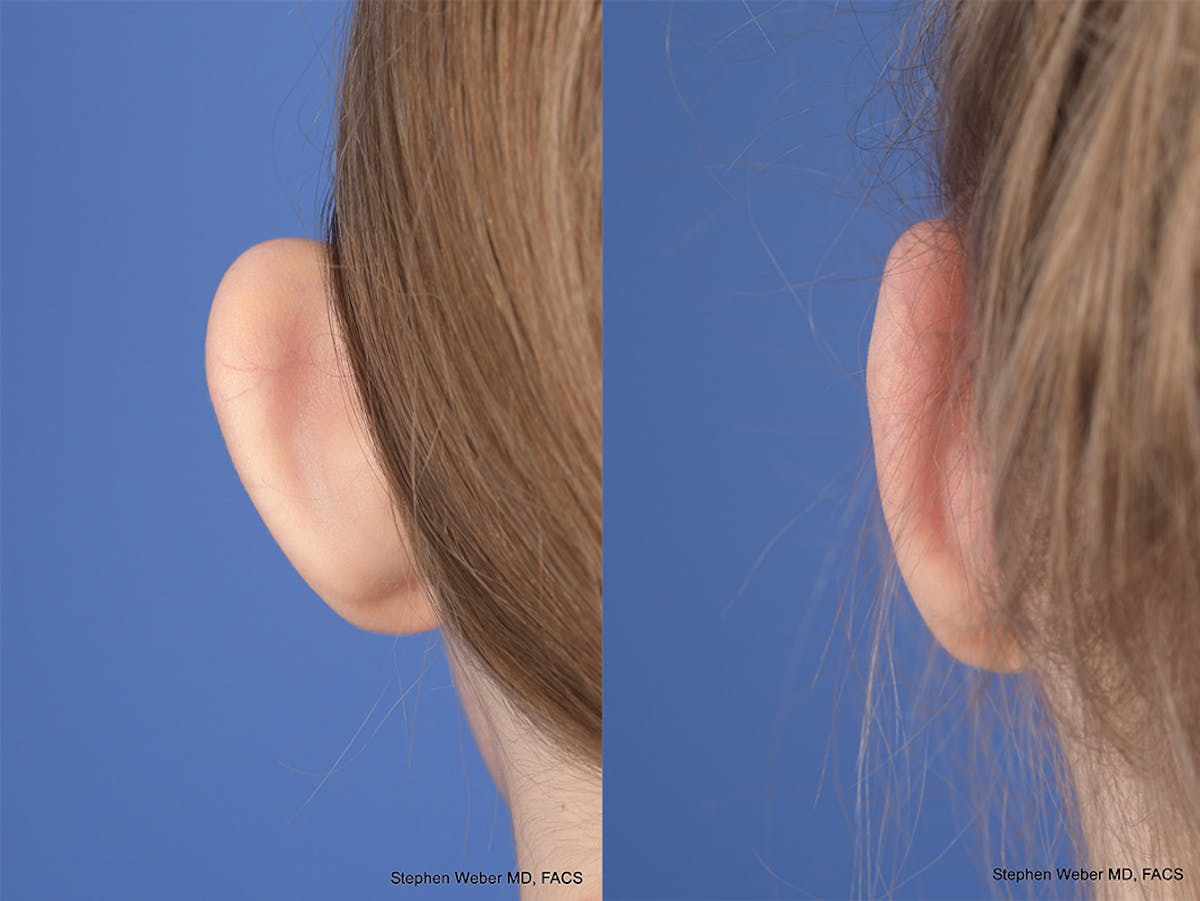 Otoplasty Before & After Gallery - Patient 276010 - Image 7