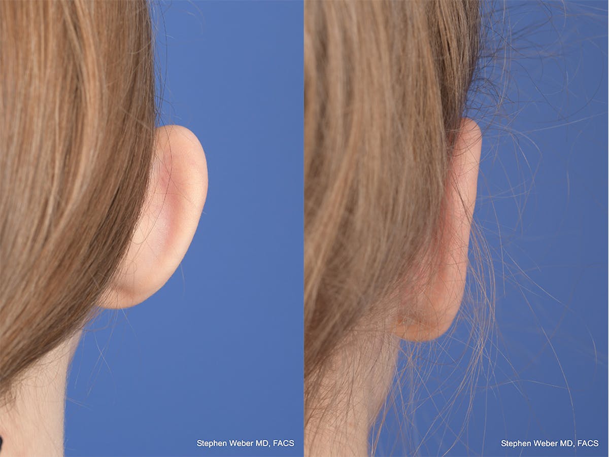 Otoplasty Before & After Gallery - Patient 276010 - Image 8