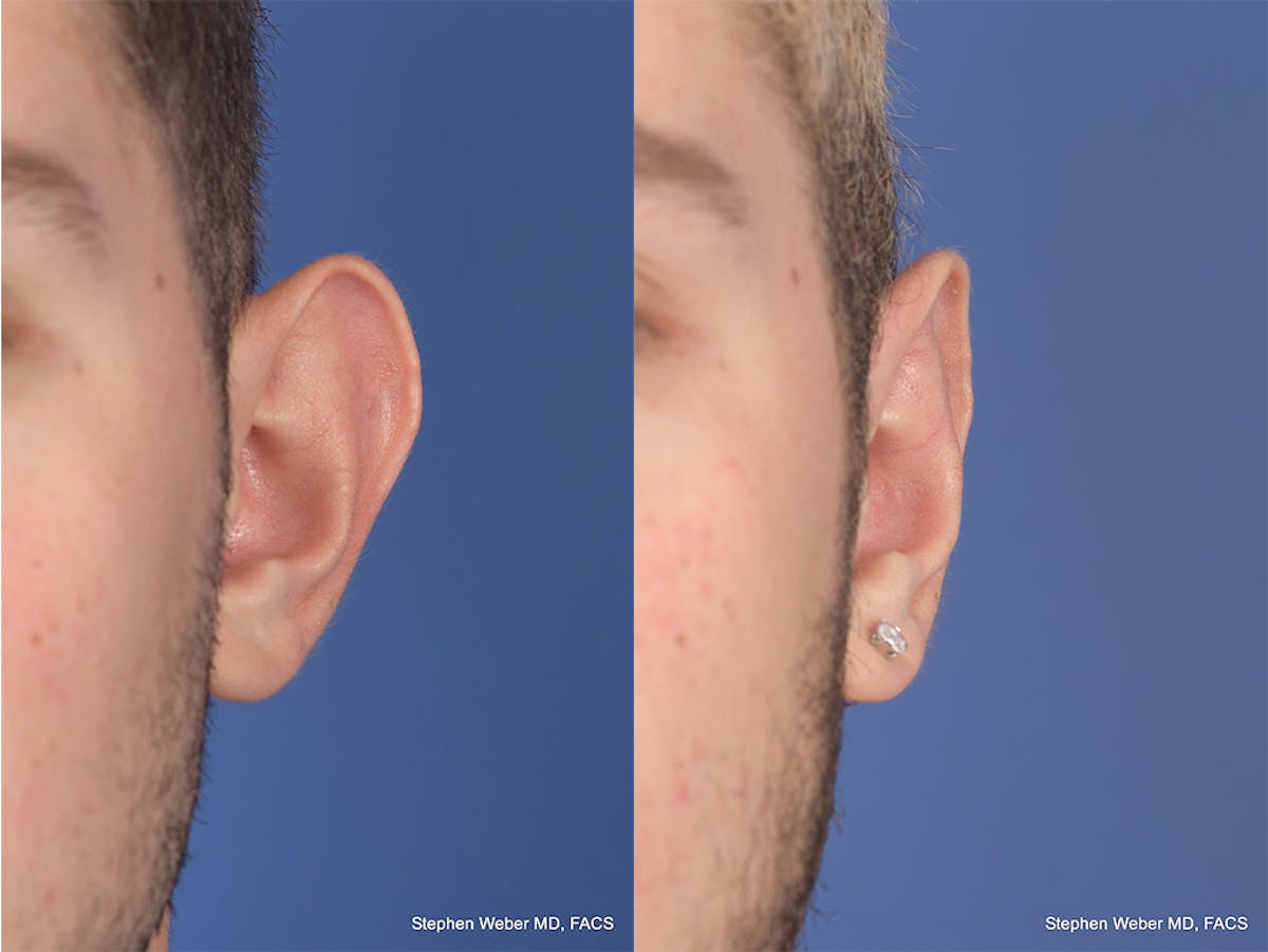 Otoplasty Before & After Gallery - Patient 104974 - Image 1