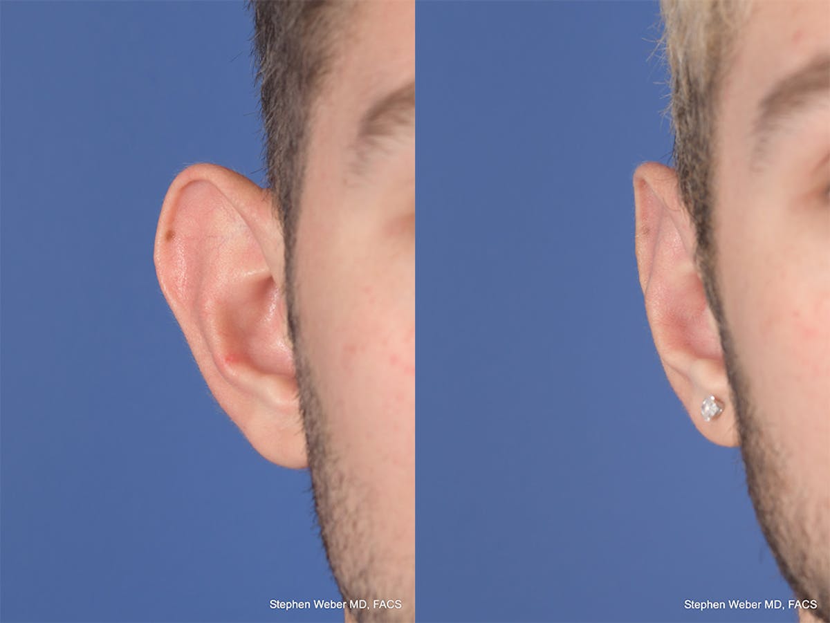 Otoplasty Before & After Gallery - Patient 104974 - Image 2