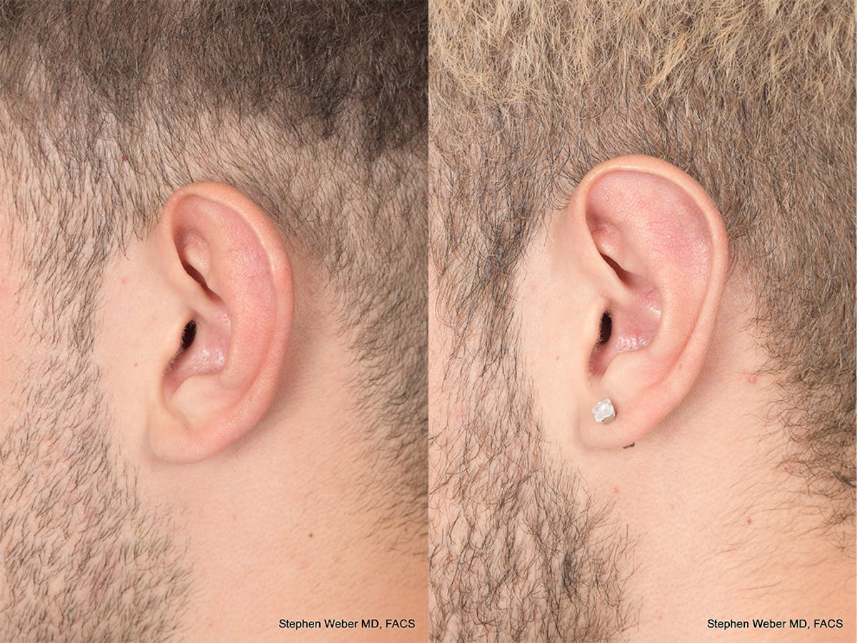 Otoplasty Before & After Gallery - Patient 104974 - Image 3