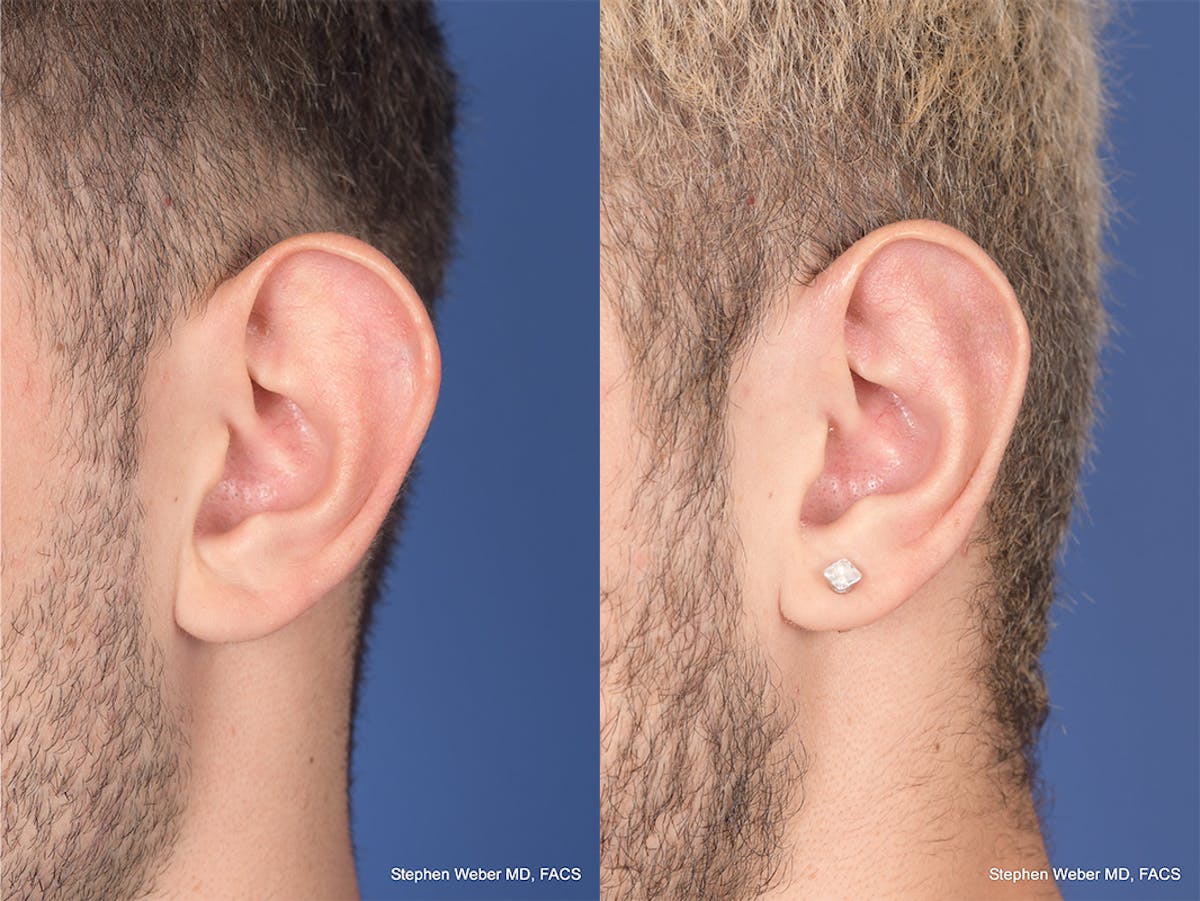 Otoplasty Before & After Gallery - Patient 104974 - Image 4