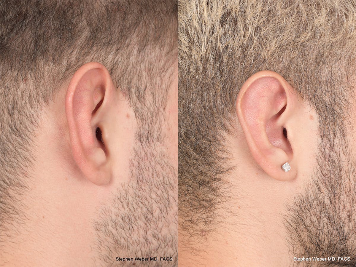 Otoplasty Before & After Gallery - Patient 104974 - Image 6