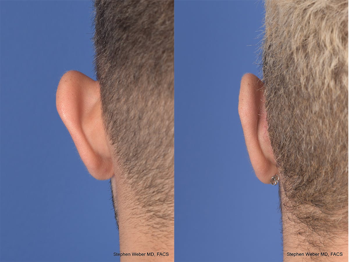 Otoplasty Before & After Gallery - Patient 104974 - Image 7