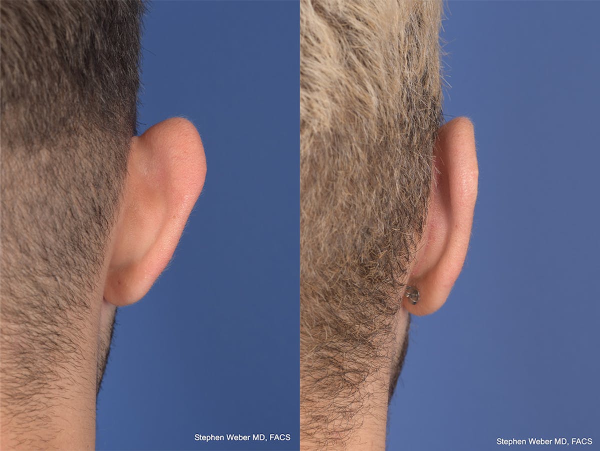 Otoplasty Before & After Gallery - Patient 104974 - Image 8