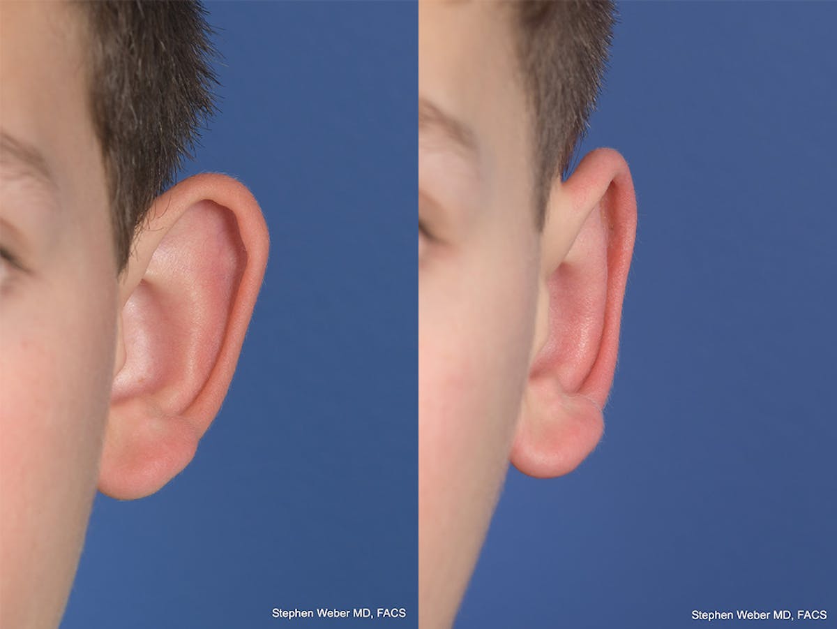 Otoplasty Before & After Gallery - Patient 297918 - Image 1