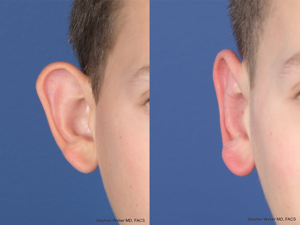 Otoplasty Before & After Gallery - Patient 297918 - Image 2
