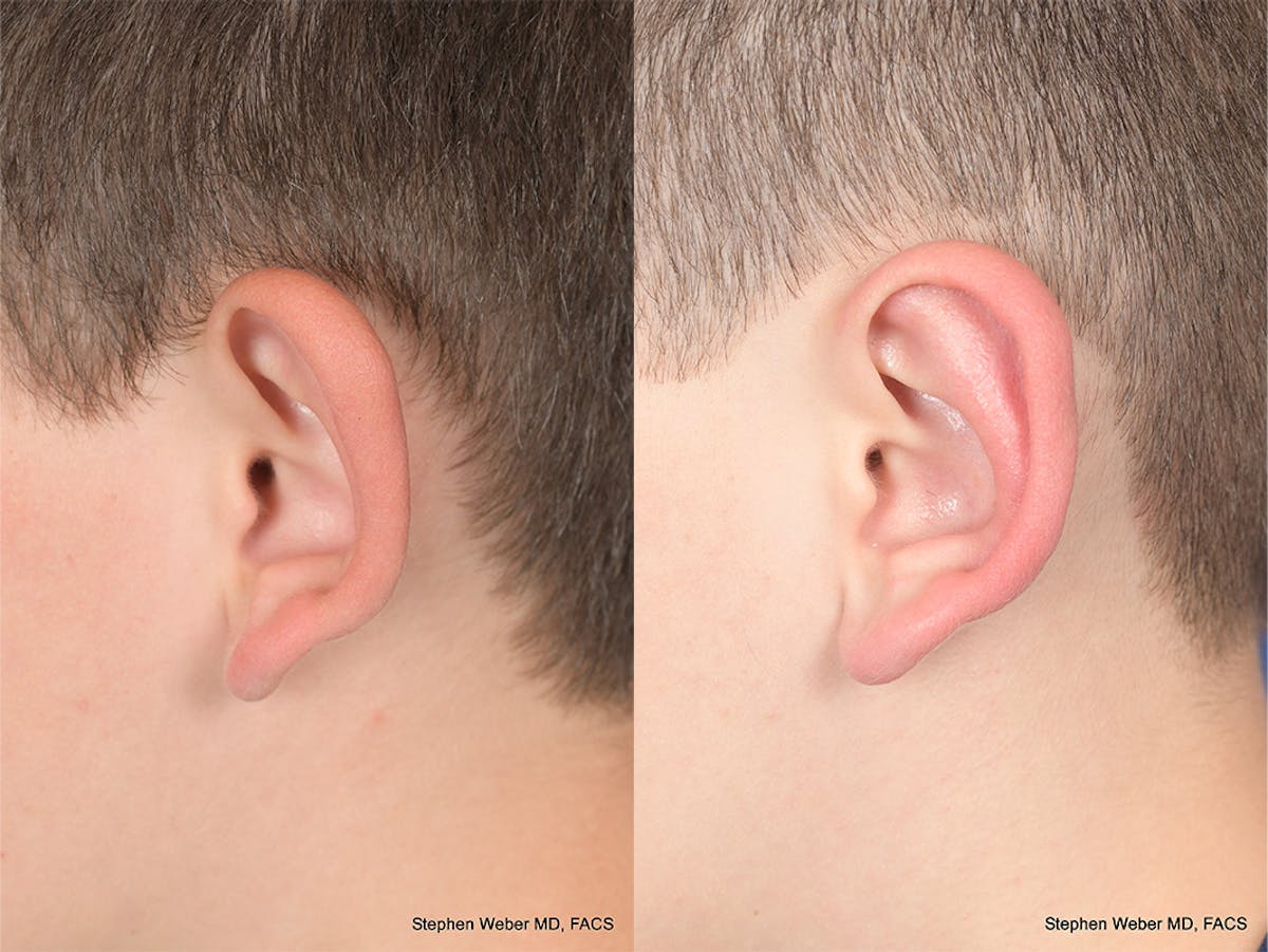 Otoplasty Before & After Gallery - Patient 297918 - Image 3