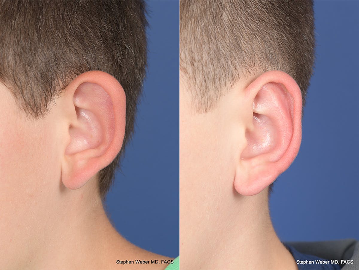 Otoplasty Before & After Gallery - Patient 297918 - Image 4