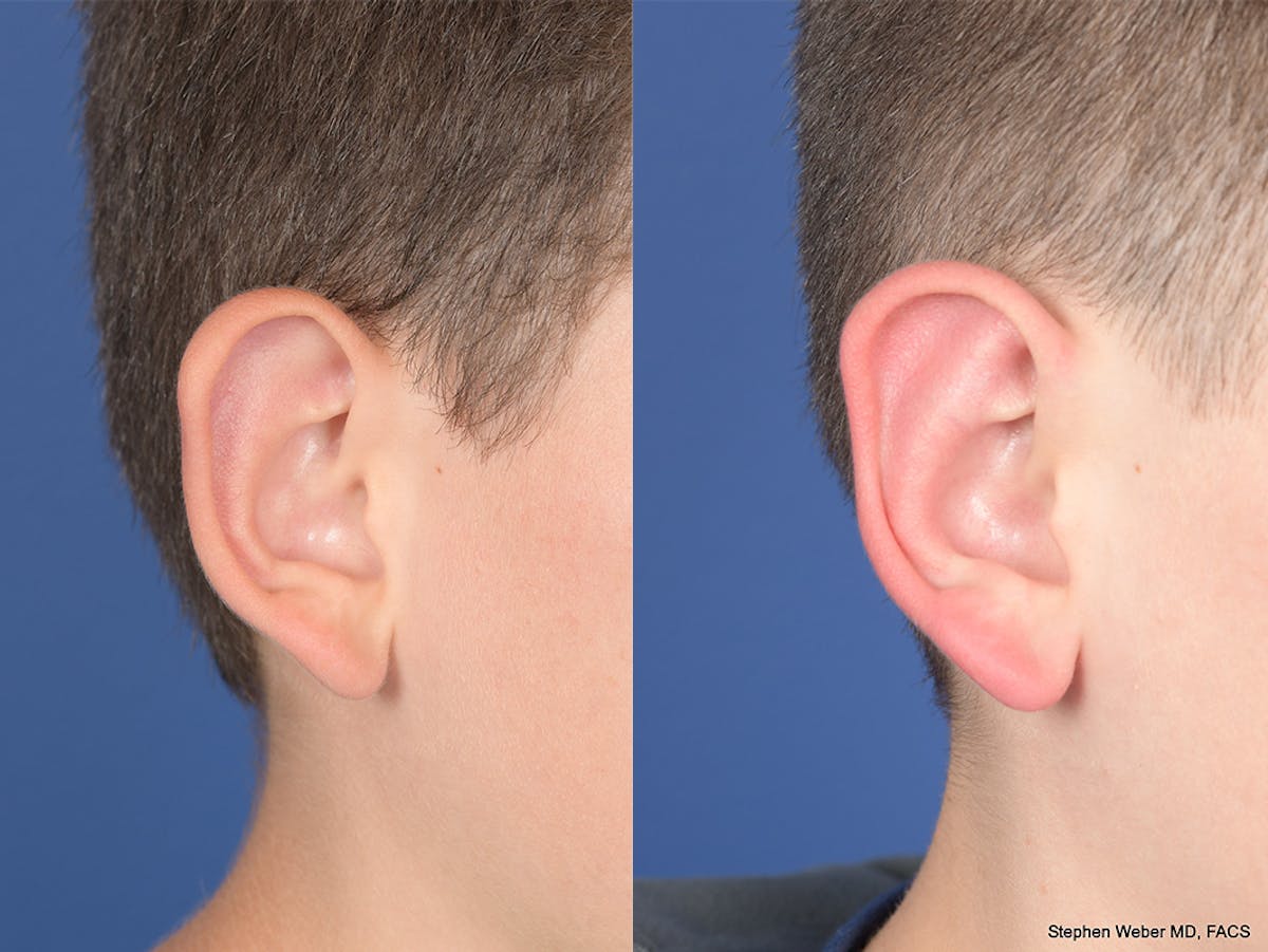 Otoplasty Before & After Gallery - Patient 297918 - Image 5