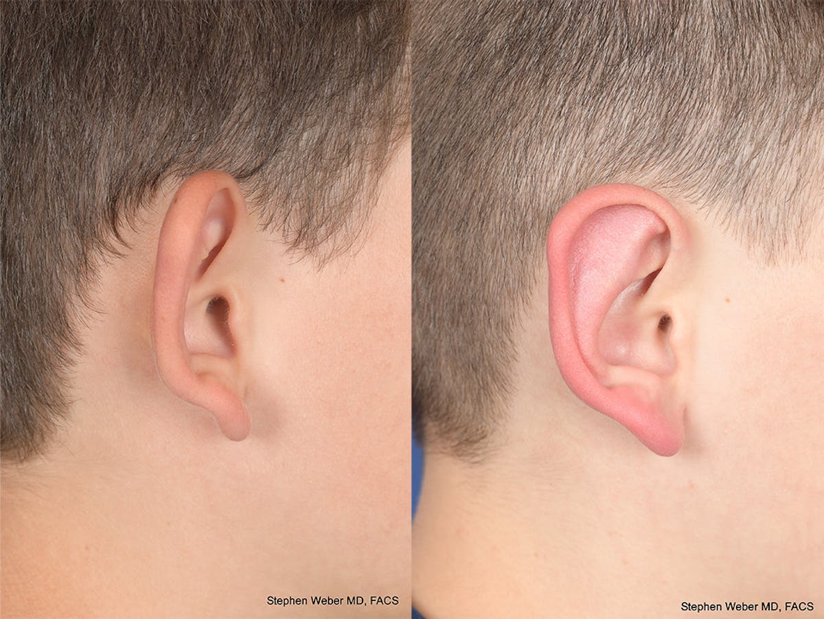 Otoplasty Before & After Gallery - Patient 297918 - Image 6