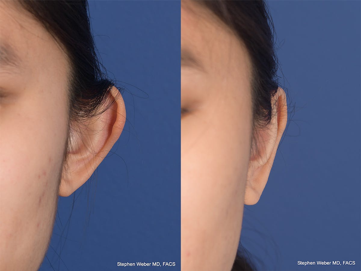 Otoplasty Before & After Gallery - Patient 276309 - Image 1