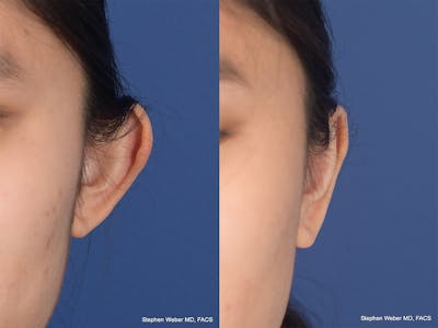 Otoplasty Before & After Gallery - Patient 276309 - Image 1