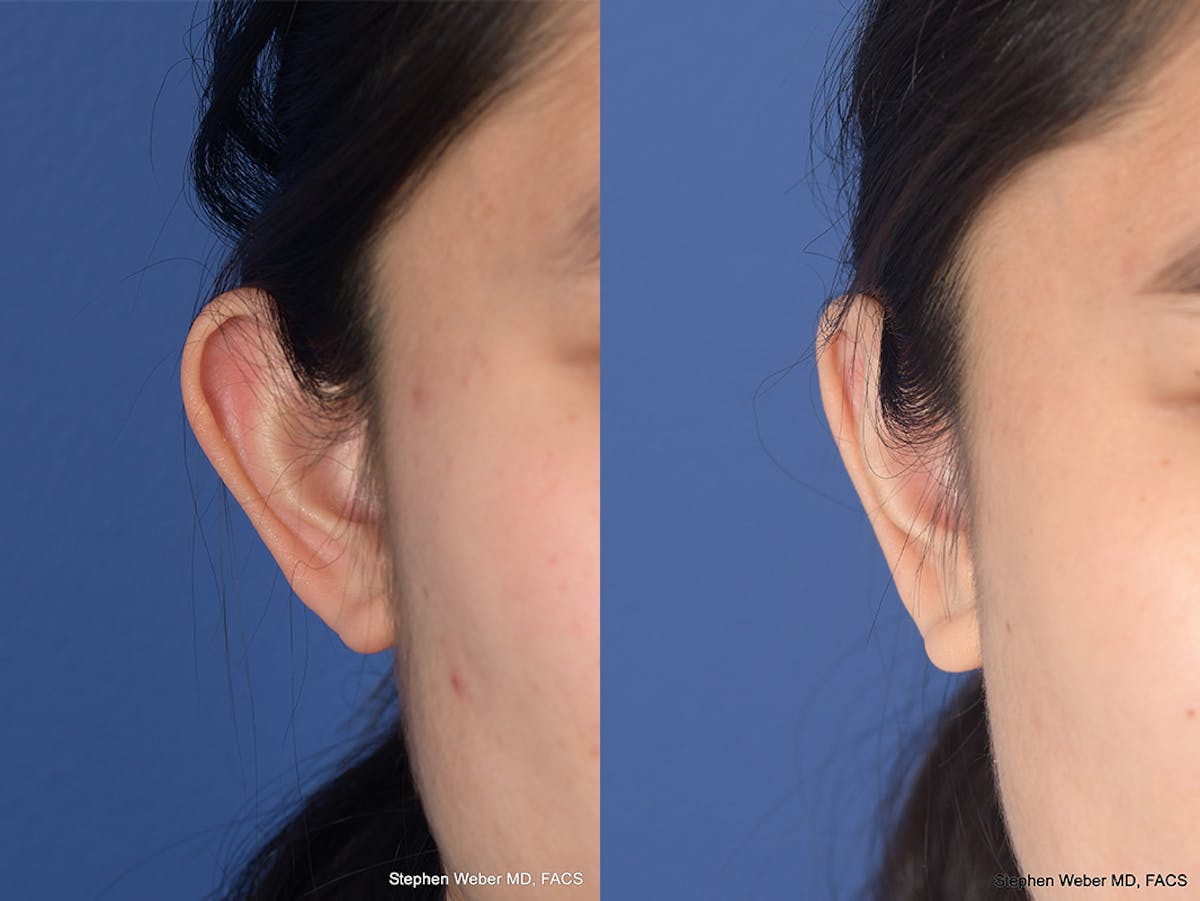 Otoplasty Before & After Gallery - Patient 276309 - Image 2
