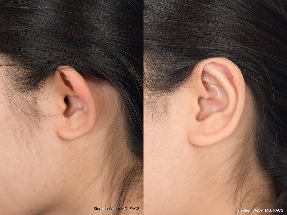 Otoplasty Before & After Gallery - Patient 276309 - Image 3