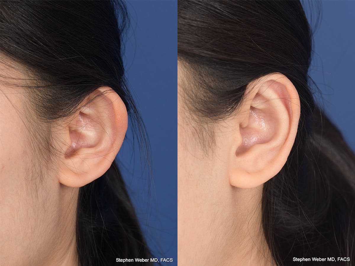Otoplasty Before & After Gallery - Patient 276309 - Image 4