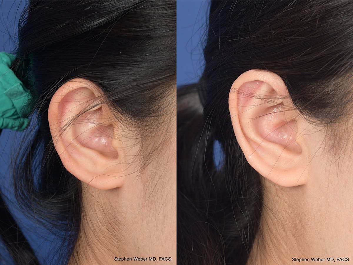 Otoplasty Before & After Gallery - Patient 276309 - Image 5