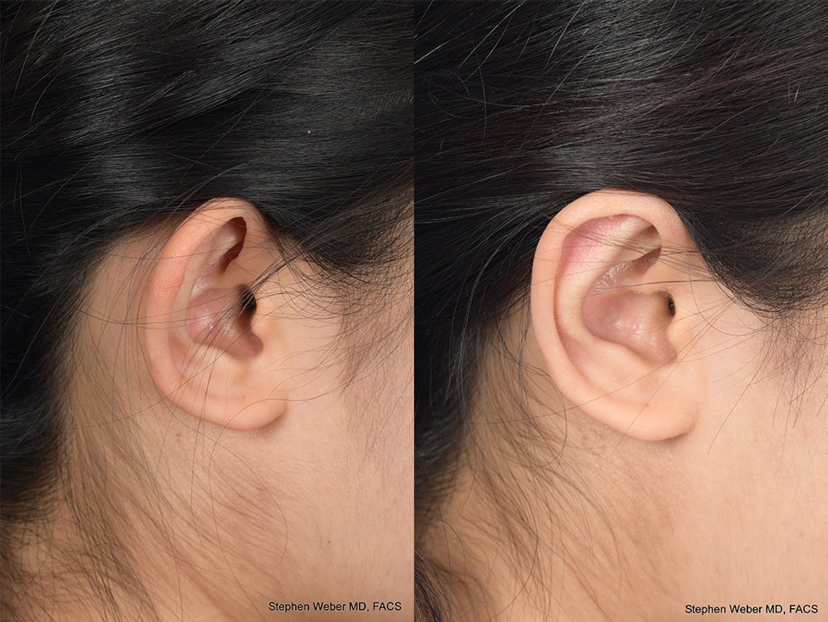 Otoplasty Before & After Gallery - Patient 276309 - Image 6