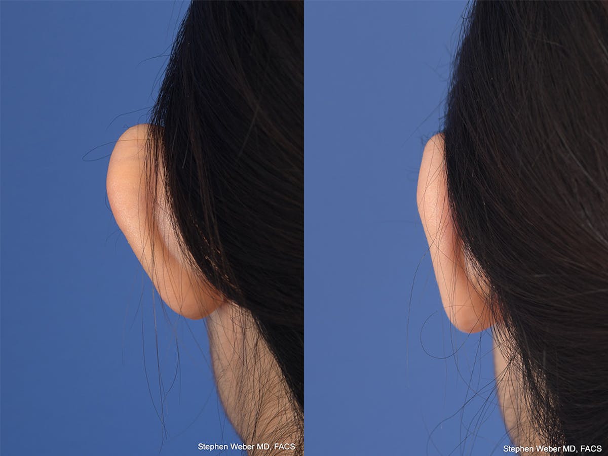 Otoplasty Before & After Gallery - Patient 276309 - Image 7
