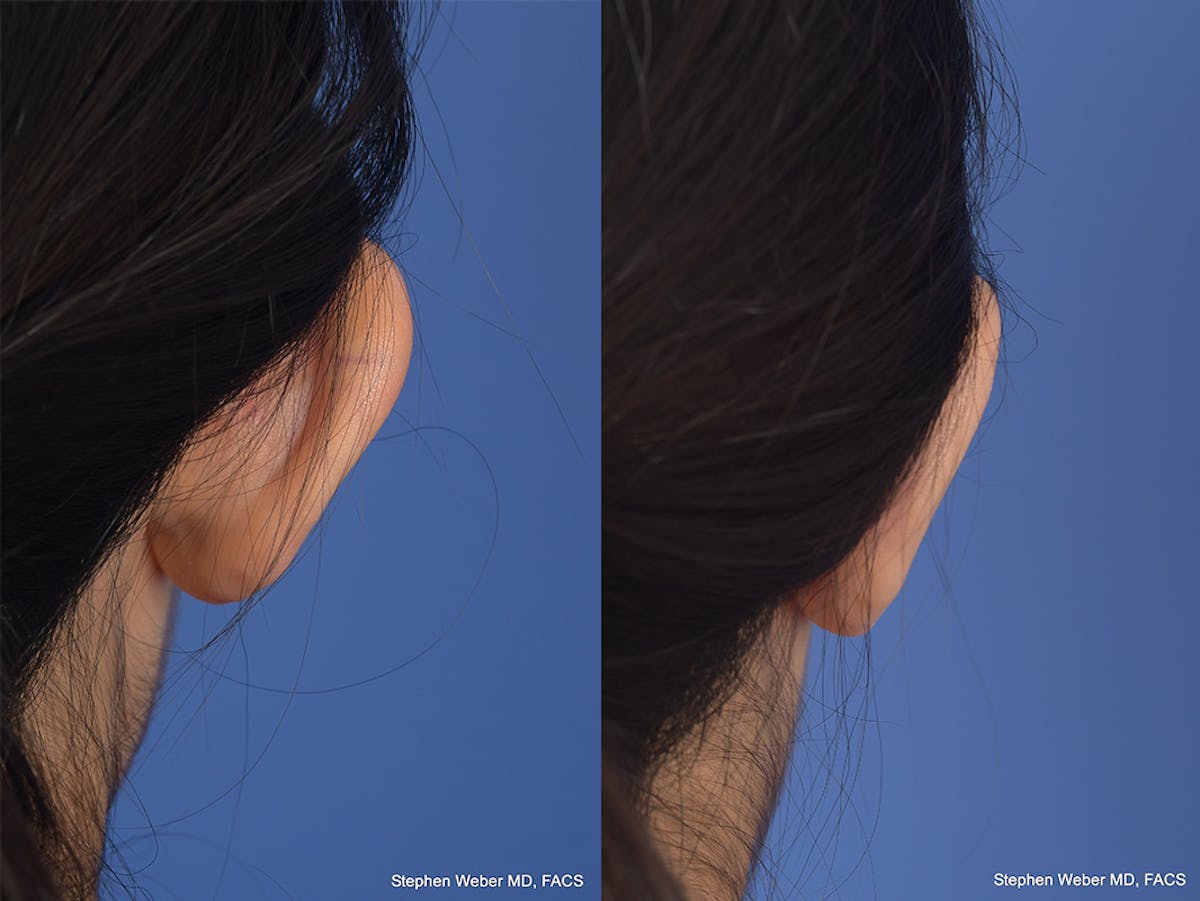 Otoplasty Before & After Gallery - Patient 276309 - Image 8