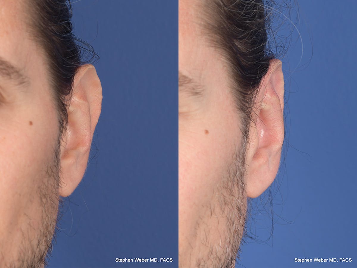 Otoplasty Before & After Gallery - Patient 158381 - Image 1