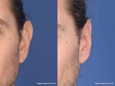 Otoplasty Before & After Gallery - Patient 158381 - Image 1