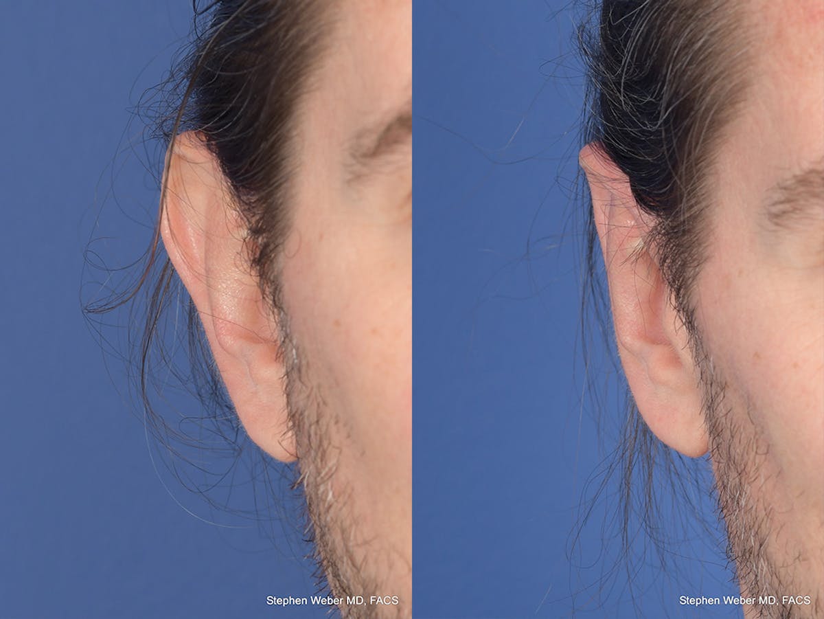 Otoplasty Before & After Gallery - Patient 158381 - Image 2