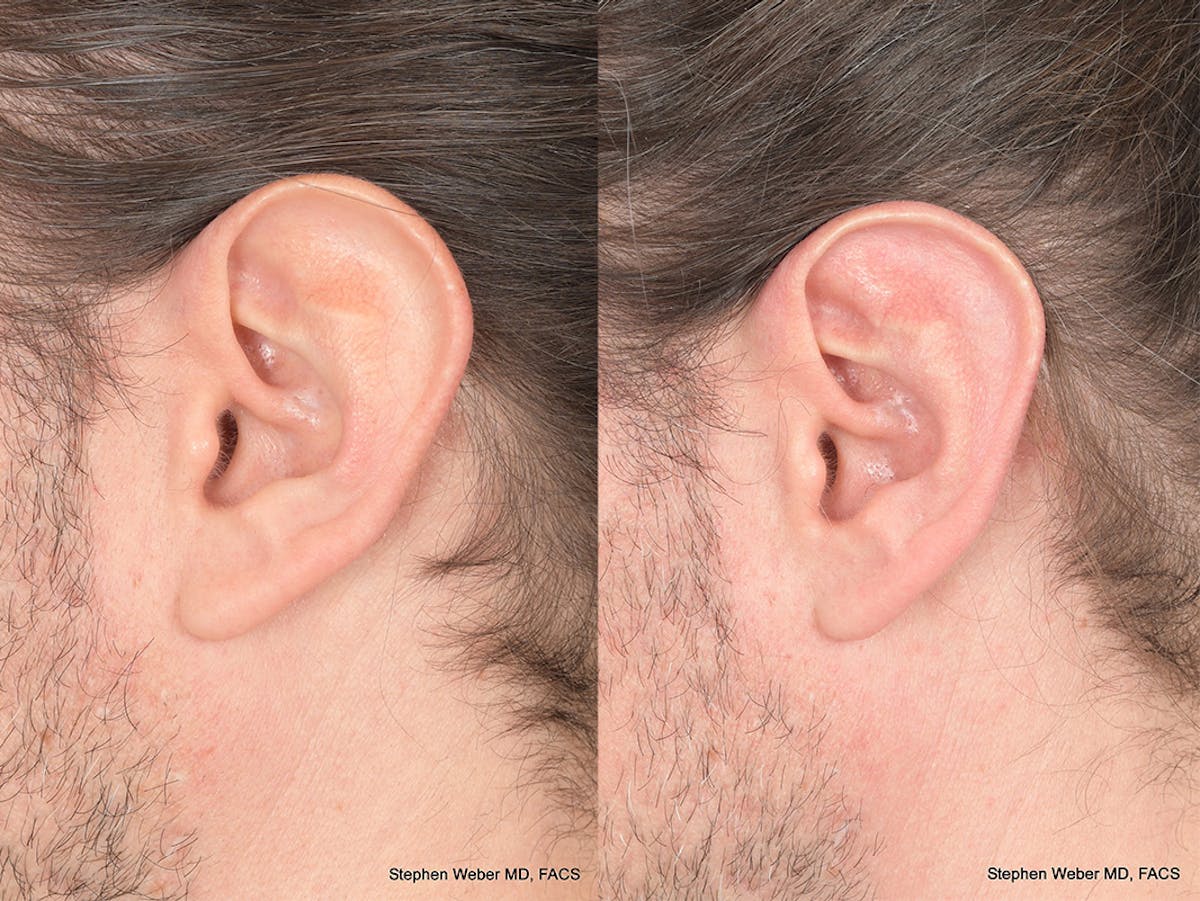 Otoplasty Before & After Gallery - Patient 158381 - Image 3