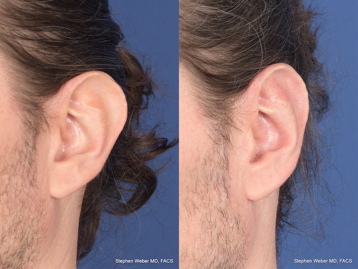 Otoplasty Before & After Gallery - Patient 158381 - Image 4