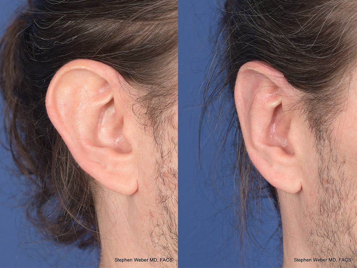 Otoplasty Before & After Gallery - Patient 158381 - Image 5