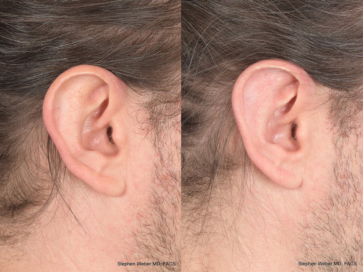 Otoplasty Before & After Gallery - Patient 158381 - Image 6