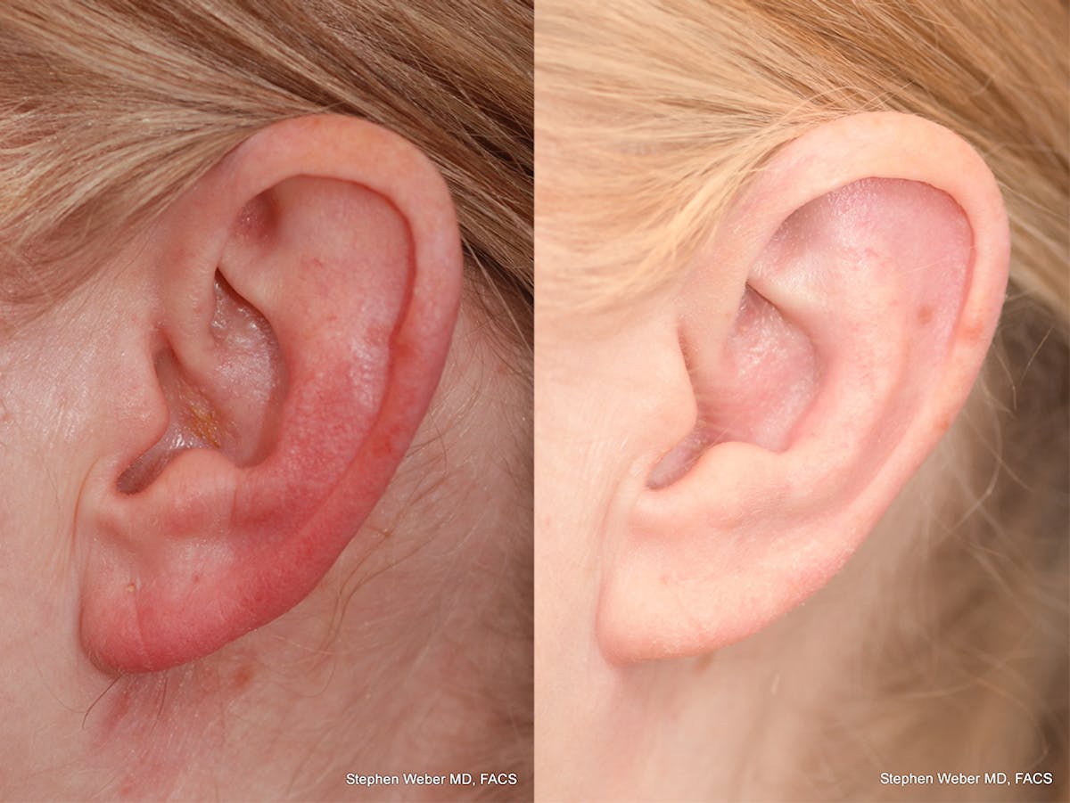 Otoplasty Before & After Gallery - Patient 348404 - Image 2