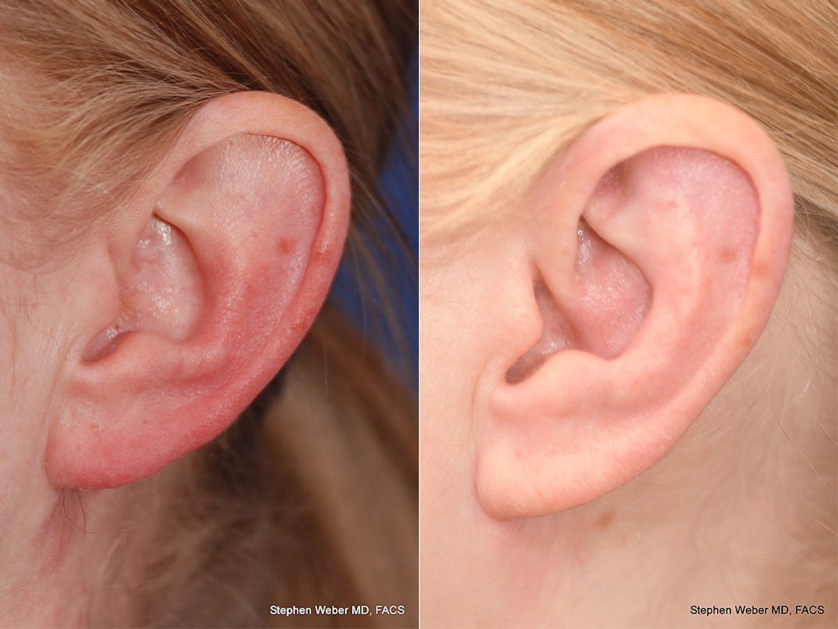 Otoplasty Before & After Gallery - Patient 348404 - Image 3