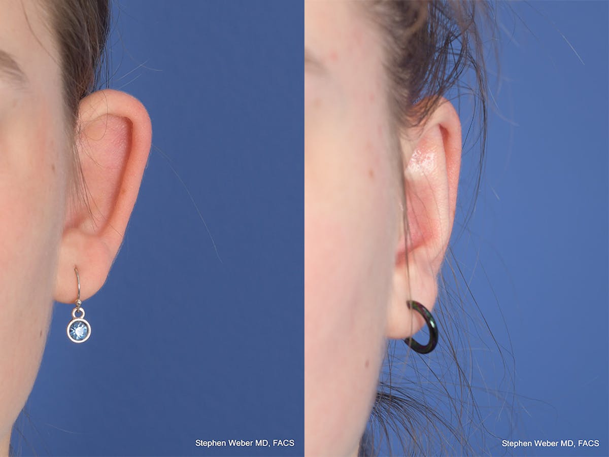 Otoplasty Before & After Gallery - Patient 367180 - Image 1