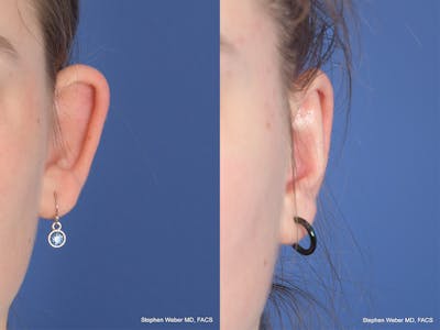 Otoplasty Before & After Gallery - Patient 367180 - Image 1