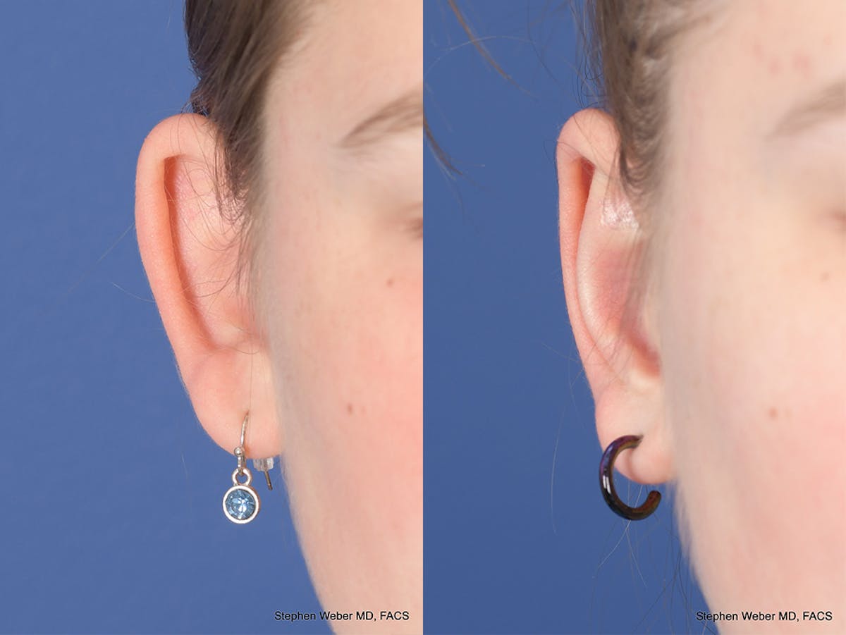 Otoplasty Before & After Gallery - Patient 367180 - Image 2