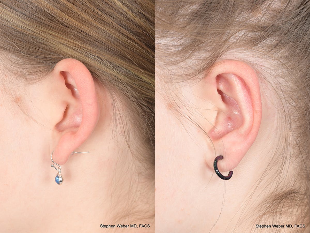 Otoplasty Before & After Gallery - Patient 367180 - Image 3