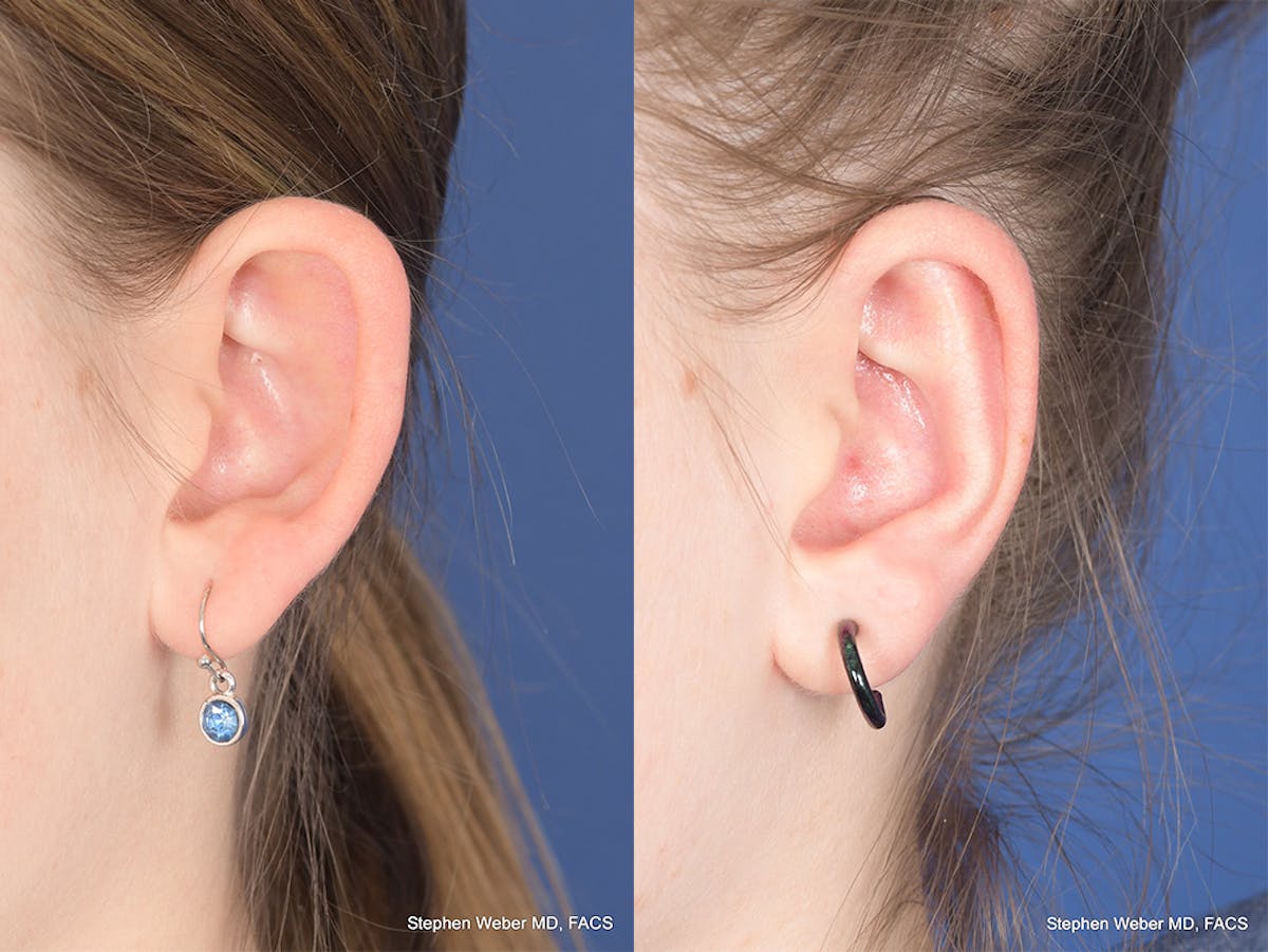 Otoplasty Before & After Gallery - Patient 367180 - Image 4