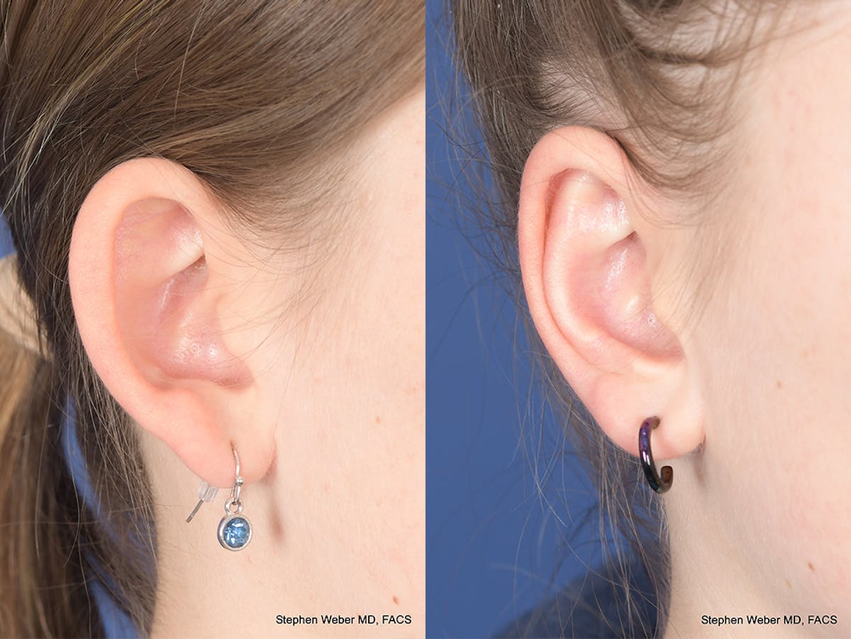 Otoplasty Before & After Gallery - Patient 367180 - Image 5