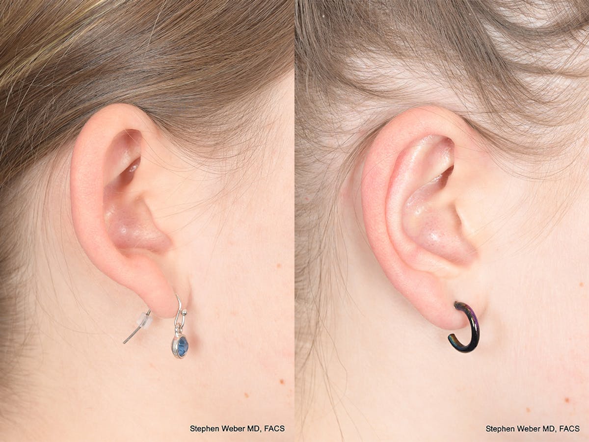 Otoplasty Before & After Gallery - Patient 367180 - Image 6