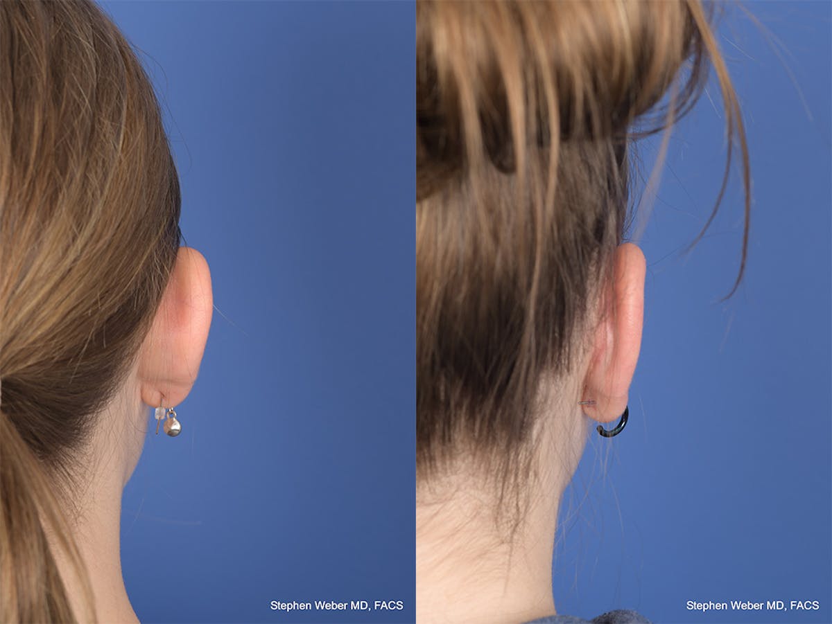 Otoplasty Before & After Gallery - Patient 367180 - Image 7