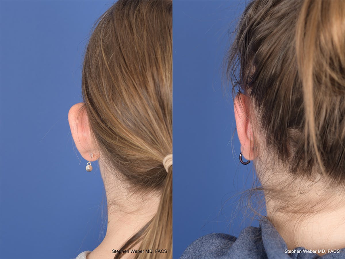 Otoplasty Before & After Gallery - Patient 367180 - Image 8